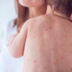 Advierten vacunarse contra el sarampión